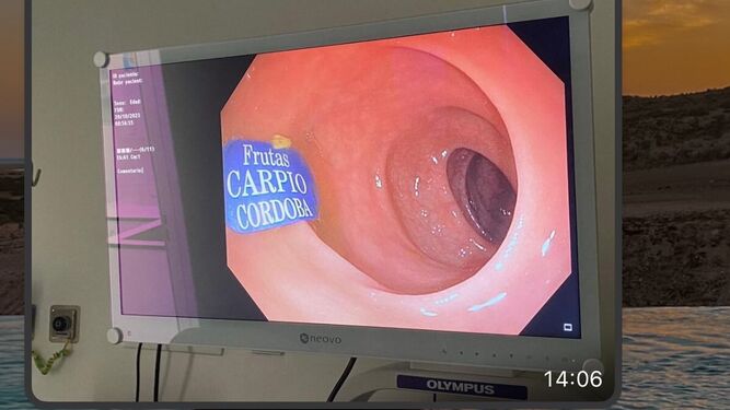 Imagen del logo de Frutas Carpio en el colon de un paciente.
