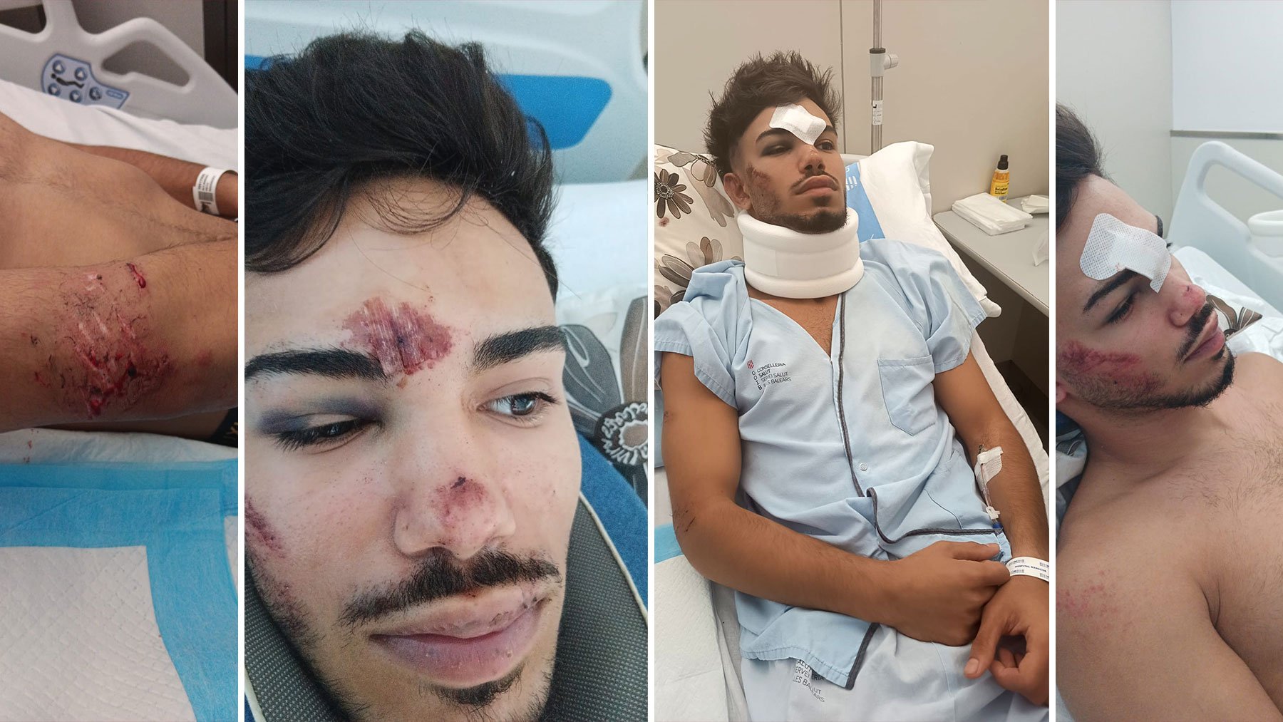 Joven de 18 años atropellado en Cala Rajada mientras se dirigía a su trabajo