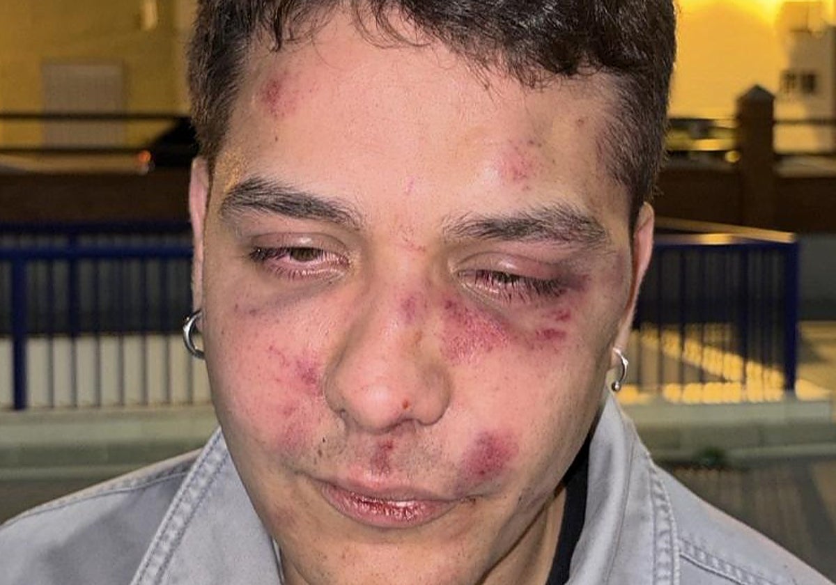 Agresión violenta a un joven tras salir de una discoteca en Málaga: "Difundid mi rostro para que no se olvide lo que hace el odio"