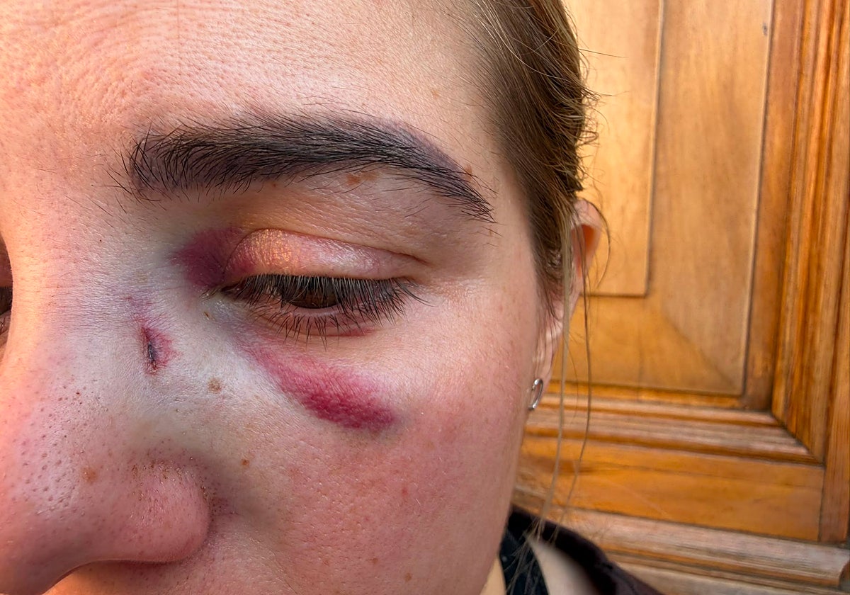 "Agresión a Doctora en Villanueva del Rosario: Paciente Le Propina Puñetazos y Provoca Fractura Nasal"