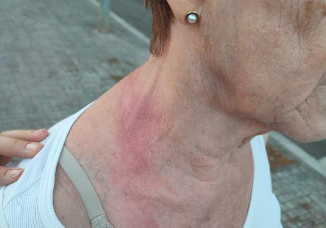 lesions (1)