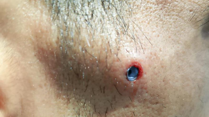 Denuncian una agresión racista a un varón herido por disparos de perdigón en Donostia: "Fue tiroteado desde un balcón"