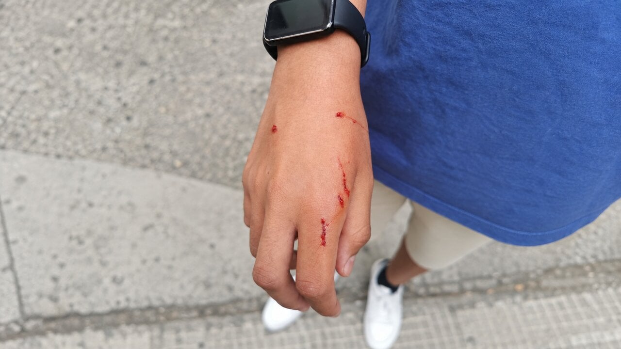 Un perro suelto muerde a un chico de 14 años en Tudela y le provoca una herida en una mano